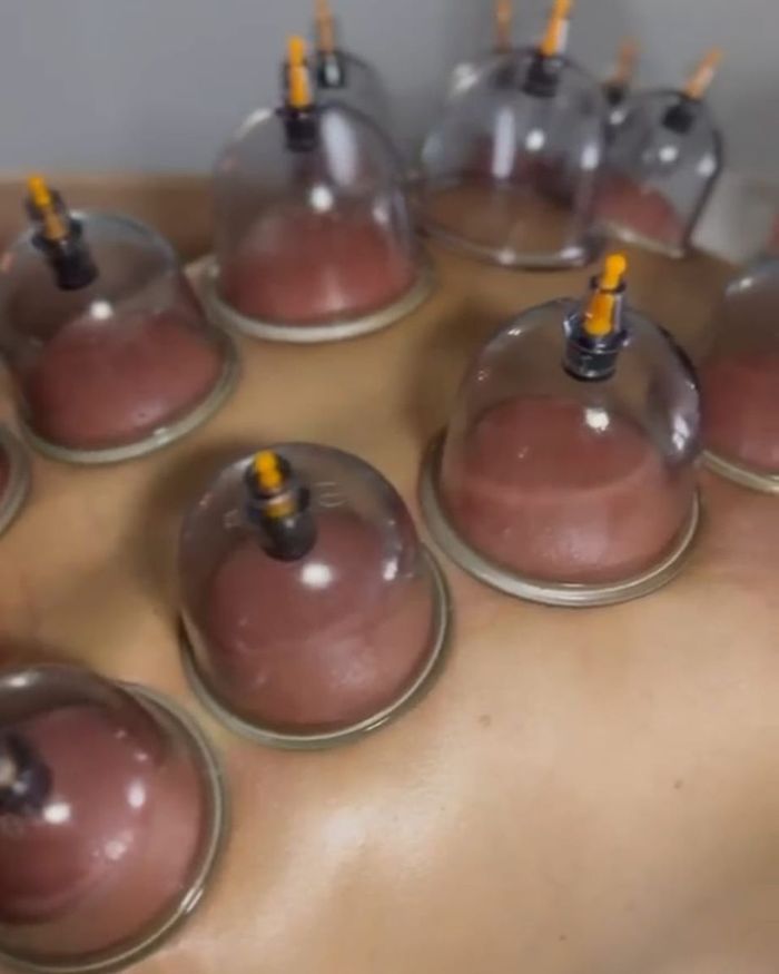 Cupping therapy — vacuum cups applied to the back showing tissue lift and increased circulation, Magic Hands, East Yorkshire